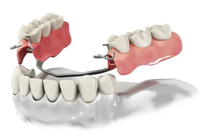 Бюгельное протезирование в Минске. Цены на бюгельные протезы на нижнюю и  верхнюю челюсть