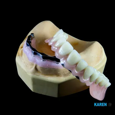 Бюгельные протезы в Астане (Нур-Султан) – Изготовление бюгельного протеза  на челюсть в стоматологии «МЛД»