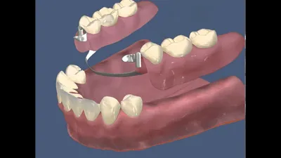 Замковый бюгельный протез - установка в стоматологии Aliksma