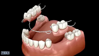Альтернатива имплантации - бюгельный протез на замках, кламмерах или  коронках