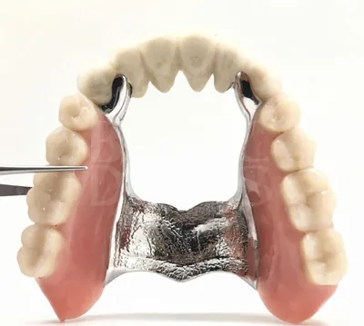 Аттачмены для протезов – что это такое, виды, фото