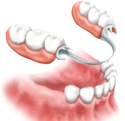 Бюгельные протезы зубов на верхнюю и нижнюю челюсть — цена, фото ❘ Ортодонт  Комплекс