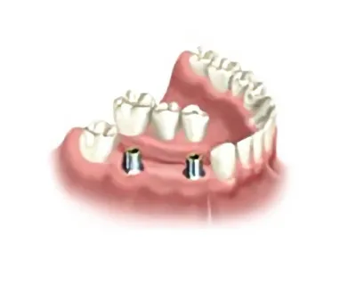 Бюгельные протезы с замками | Стоматология на Гагарина