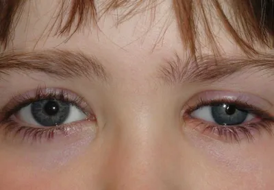 Как открыть запавшие глаза: Укрепляем круговую мышцу глаза за 3 минуты |  Econet Здоровье | Дзен