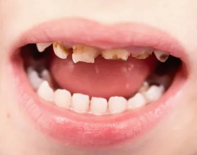 Запущенные Зубы — Причины, Последствия И Лечение (2024)