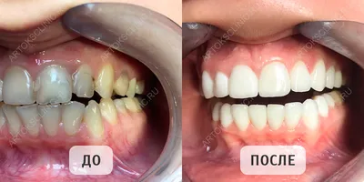 Запущенные Зубы — Причины, Последствия И Лечение (2024)