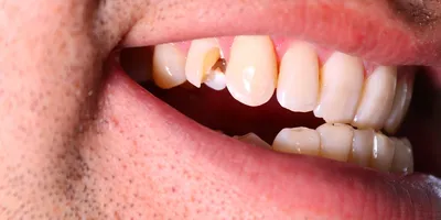 плохие зубы крупного плана стоковое изображение. изображение насчитывающей  клиника - 13048313