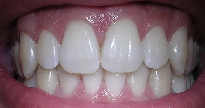 10 серьезных заболеваний от недолеченных зубов — TOMSK.RU