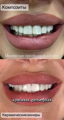 Чёрные зубы: почему они темнеют и как с этим бороться?