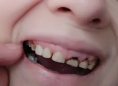 Плохие зубы - все можно исправить!