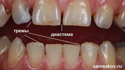 Плохие зубы могут быть одной из причин инсульта и многих других заболеваний  | Yle