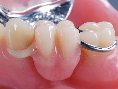Болезнь XXI века: почему зубы больше 90% людей на Земле разрушает кариес |  DOCTORPITER