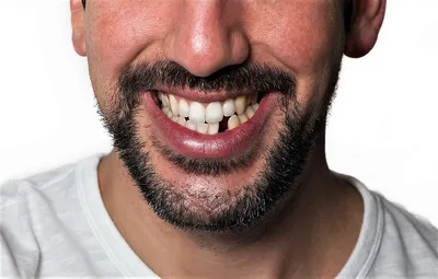 Желтые зубы причины и способы устранения желтизны зубов в Севастополе в  стоматологии | Жемчуг