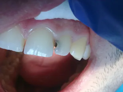 Когда зубы гнилые в хлам — случай пациента, которому это знание обошлось в  1,5 миллиона / Хабр