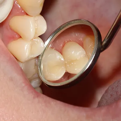 Средний кариес: симптомы и методы лечения постоянных зубов