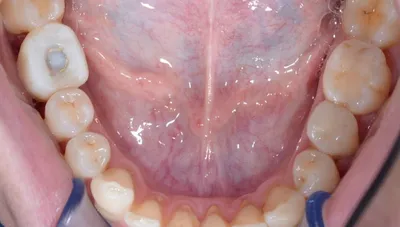 Сверхкомплектные зубы – как лечить