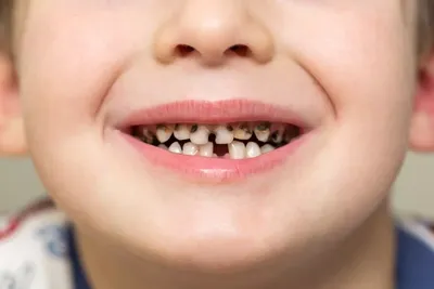 Детская стоматология и ортодонтия в Киеве - блог доктора Пешко Татьяны  Евгеньевны: Некариозные поражения молочных зубов - гипоплазия эмали,  несовершенный амелогенез