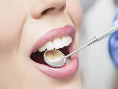 Реставрация зубов - показания и противопоказания, методы, этапы и  подготовка к процедуре