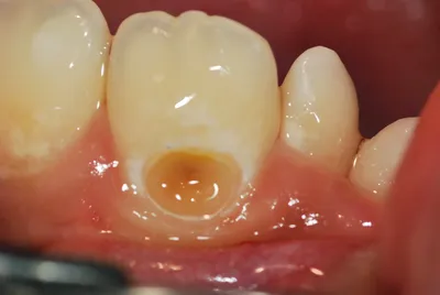 Implant Dental Service - Зубы-это не только Красота👄, но и ЗДОРОВЬЕ🦷  Человек имеющий плохие зубы, не следящий за ними имеет в 80%случаев  заболевания Желудочно-кишечного тракта🤢 Если пища плохо измельчена в  полости рта,