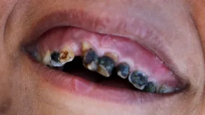 Срочное лечение зубов. 8 признаков, что вам нужно к стоматологу - \"Фортуна\"