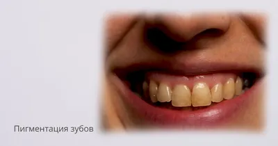 Выпадение зубов у взрослых причины и симптомы пройти лечение | Стоматология  Жемчуг