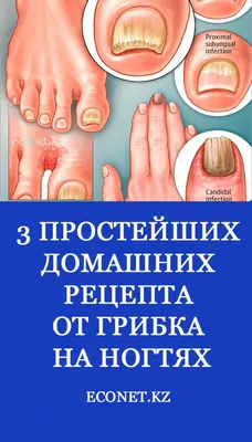 Лечение грибка ногтей - заказать онихомикоз лечение в Киеве и Украине,  выгодная цена на лечение ногтевого грибка в клинике косметологии Медлас