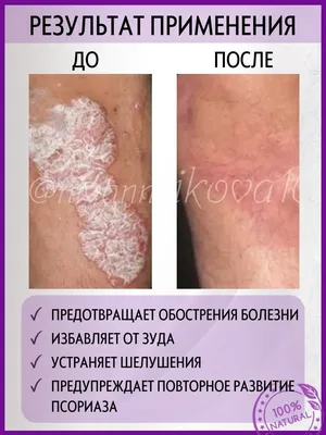 Медицинский центр AS Clinic в г. Астана on Instagram: \"Псориаз (чешуйчатый  лишай) — воспалительное заболевание кожи, возникающее в результате  нарушения созревания клеток кожи, характеризующееся многообразными  проявлениями. Доказан наследственный фактор ...