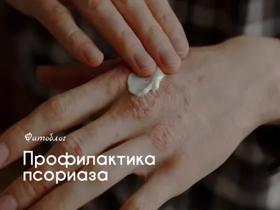 Псориаз Центр Барнаул\" предлагает ПУВА-терапию при псориазе