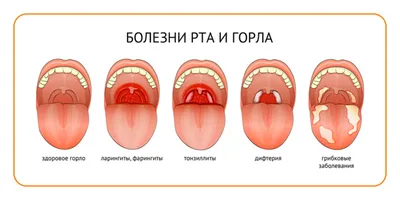 Чем лечить горло ребенку — блог Фурасол®