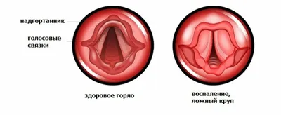 Мононуклеоз: что это, симптомы у детей, признаки, лечение, как передается,  последствия