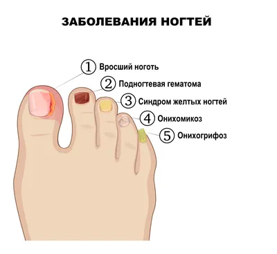 Врач сообщила, что цвет ногтей на ногах говорит о здоровье человека |  Новости ЗОЖ | Здоровый Образ Жизни