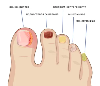 Утолщение ногтей - причины появления, при каких заболеваниях возникает,  диагностика и способы лечения