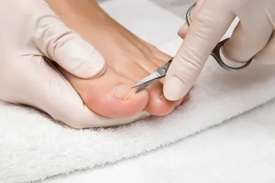 Не покрывайте ногти на ногах гель-лаком. Подологи против нанесения  гель-лака на ногти ног, и вот почему: | МедЛайн — Клиника эстетической  медицины | Дзен