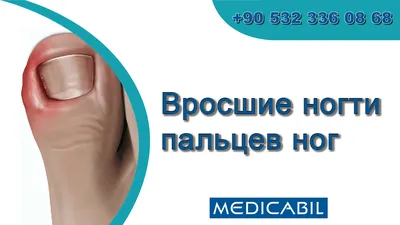 Лечение скрученного ногтя: причины – что делать, если скручивается ноготь  на большом пальце ноги