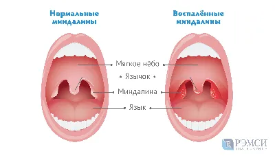 Воспаление нёба (палатинит): причины, симптомы, диагностика, лечение  воспаления нёба верхнего, твёрдого, мягкого