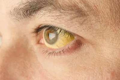 Должна ли присутствовать небольшая желтизна белков глаз, при закатывание? -  Вопрос гепатологу - 03 Онлайн