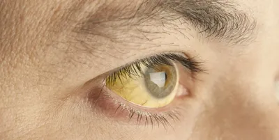 Из-за чего желтеют белки глаз? | блог Хирургия глаза