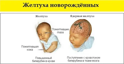 Желтые белки глаз у новорожденного: возможные причины, описание с фото,  возможные проблемы и рекомендации педиатров