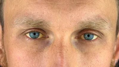 Желтые склеры. Желтые белки глаз - лечение в Кызыле | «Санталь Кызыл»  (Республика Тыва)