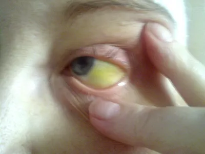 Pinguecula отмечает взорвать фотографии макротипа мужского глаза. Желтый  образование на фермеров белки отмечает Стоковое Изображение - изображение  насчитывающей глаз, мужчина: 191181727