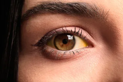 Почему желтеют белки глаз и что с этим делать - Рамблер/доктор