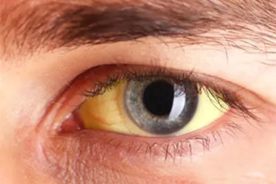 Темные круги под глазами - причины появления, симптомы заболевания,  диагностика и способы лечения