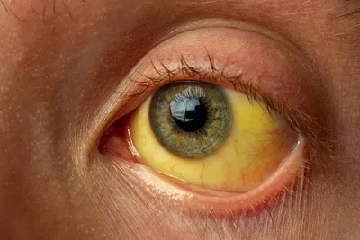 Стало известно, что рак можно выявить по состоянию глаз | ИА  “ОнлайнТамбов.ру”