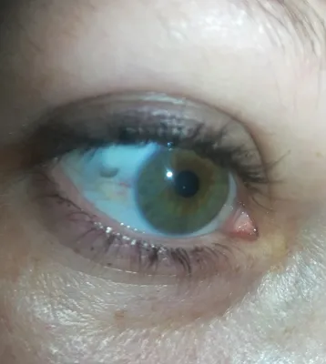 Офтальмолог Ивановская Наталья Алексеевна - Почему желтеет склера глаза,  какие причины вызывают это явление ?! ⠀ Если обнаружены желтые склеры глаз,  причины такого явления могут быть разными. Чаще всего они свидетельствуют о