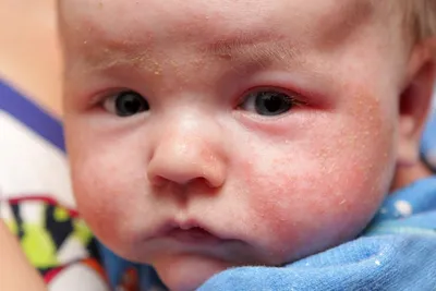 Угри на лице и коже у ребенка — причины, симптомы и лечение угревой сыпи