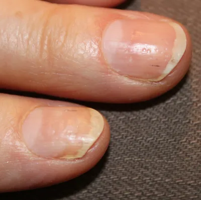 Лечение и профилактика лейконихии, белых пятнен на ногтях — Центр подологии  СТОПАМЕР