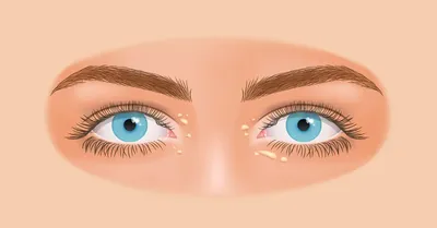 Желтые пятна на веках глаз: причины, диагностика и лечение в ГКДБ
