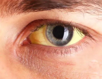 Желтые белки глаз - причины и лечение