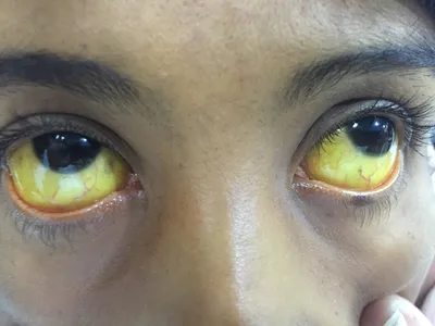 Желтые глаза - Вопрос гастроэнтерологу - 03 Онлайн