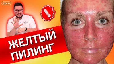 Желтый пилинг Sesderma в Симферополе • Mezo Clinic